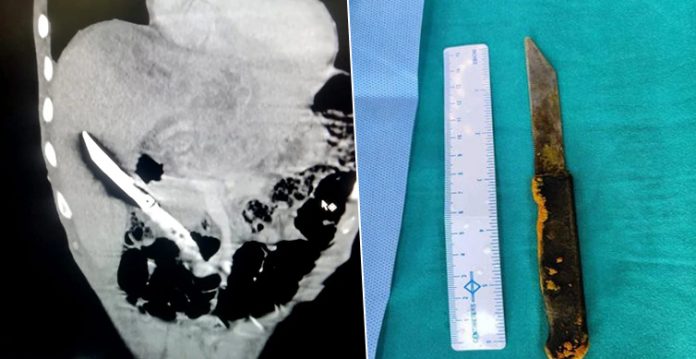 AIIMS doctors save patient who swallowed 20cm knife