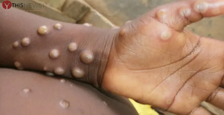 monkeypox