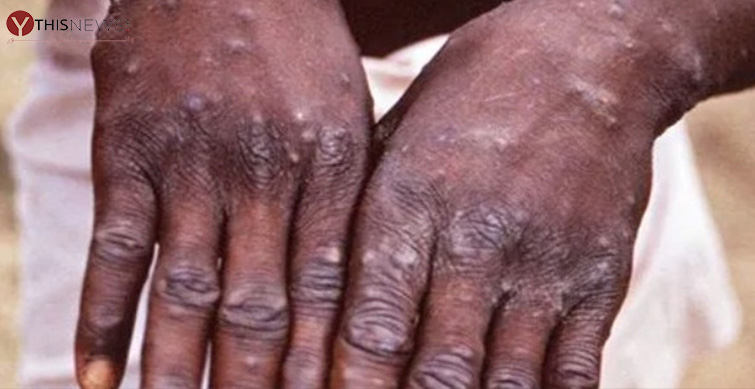 Monkeypox