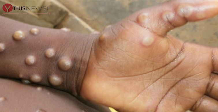 monkeypox