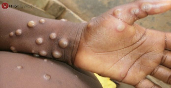 Monkeypox Symptoms