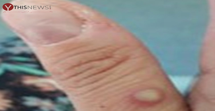 monkeypox