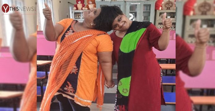 Conjoined twin sisters Vani and Veena