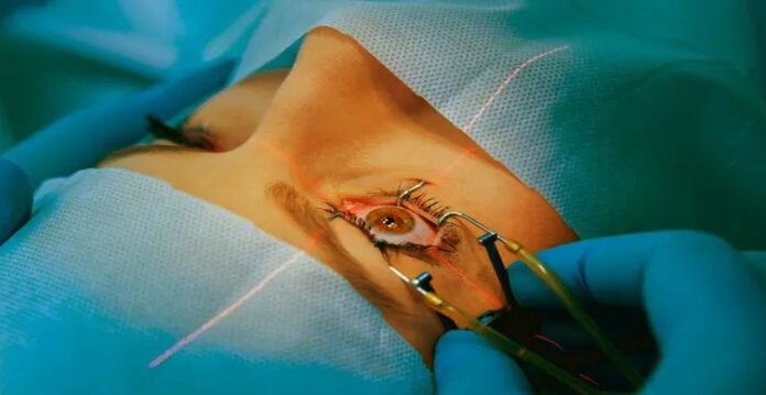 catract surgery